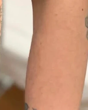 Tetovanie pred laserovým ošetrením