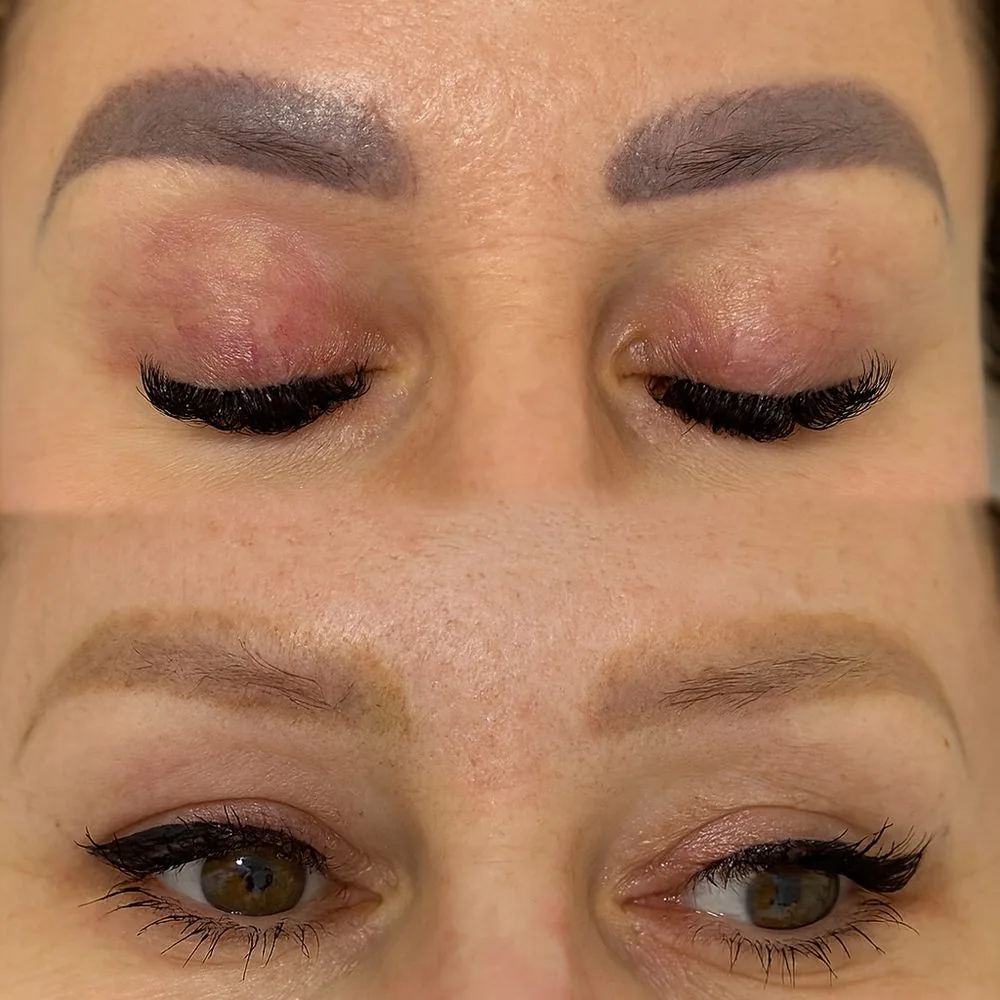 Permanentný make-up obočia pred laserovým zosvetlením a po ňom